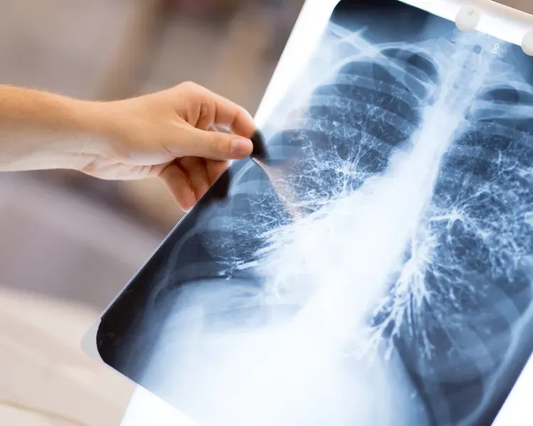 an image of an arm  holding a chest x-ray