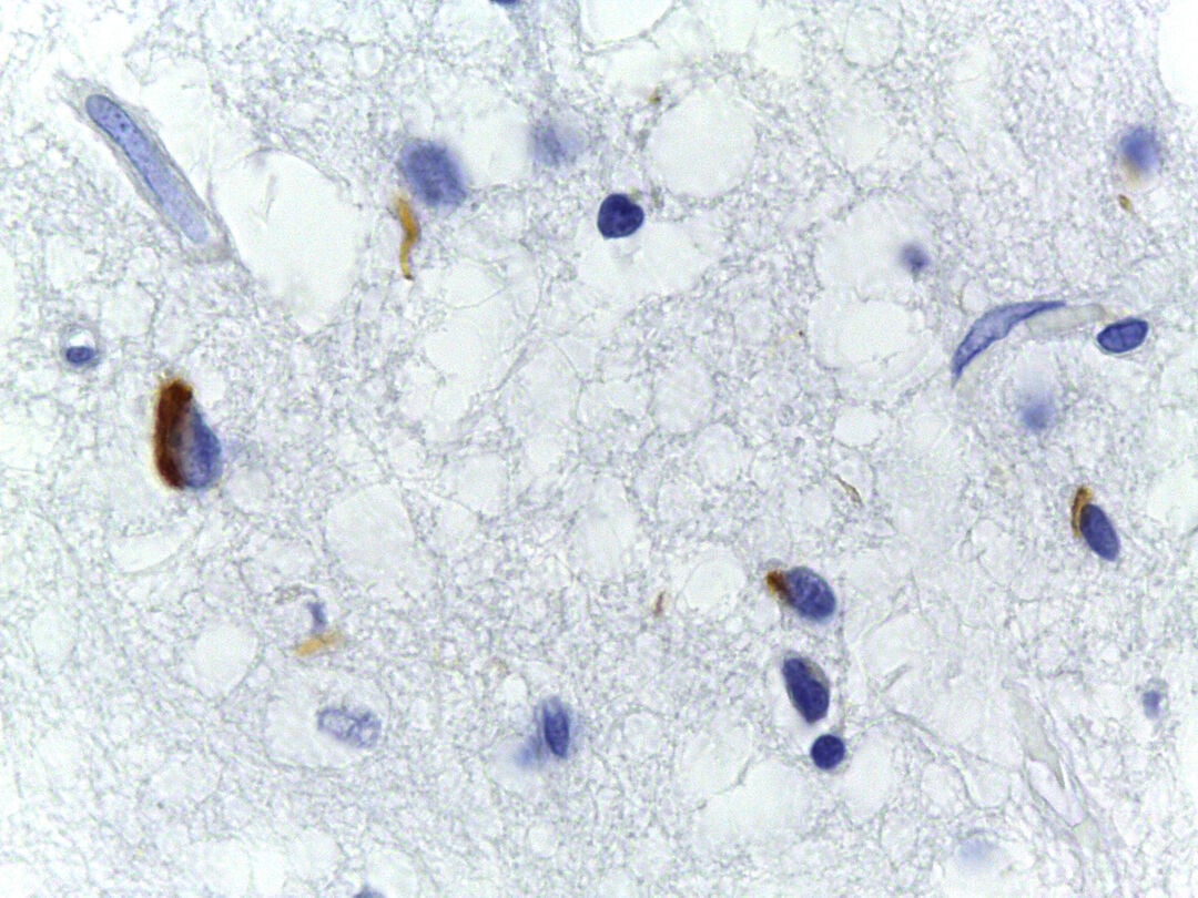 Brain tissue from a person with frontotemporal dementia examined for TDP-43 build-up (TDP-43 is the brown colour)